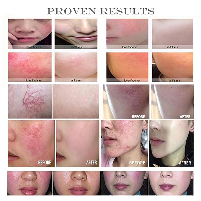 Keratinocyte Growth Factor Powder - KGF Freeze-Dried Powder Cosmetic Grade for Sensitized Skin, 1Milligrams, 900000IU, 96% Purity (500μg)