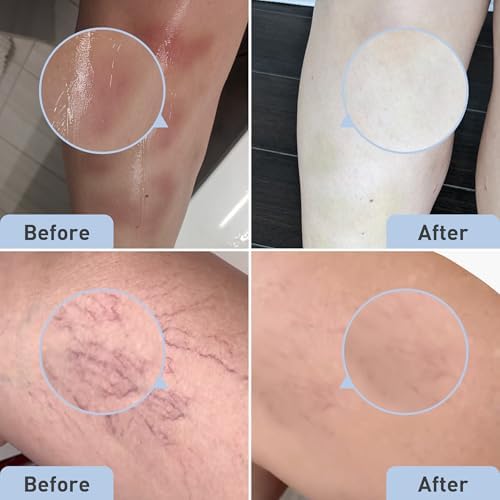 PROcure Remedy Gel with Arnica, Helps Improve the Appearance of Bruises & Spider Veins on the Foot and Ankle, Unscented & Paraben Free with Soft Touch Applicator, 2 Fl Oz