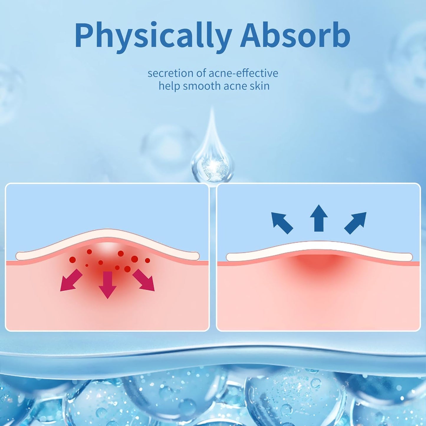 Large Hydrocolloid Acne Pimple Patches | 142 Count | 6 Sizes for Face & Body