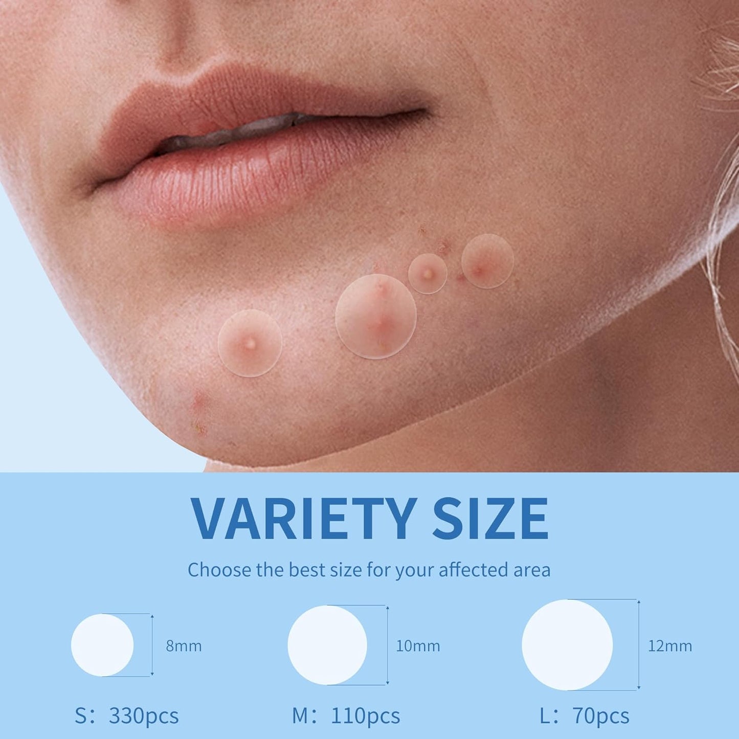 Large Hydrocolloid Acne Pimple Patches | 142 Count | 6 Sizes for Face & Body