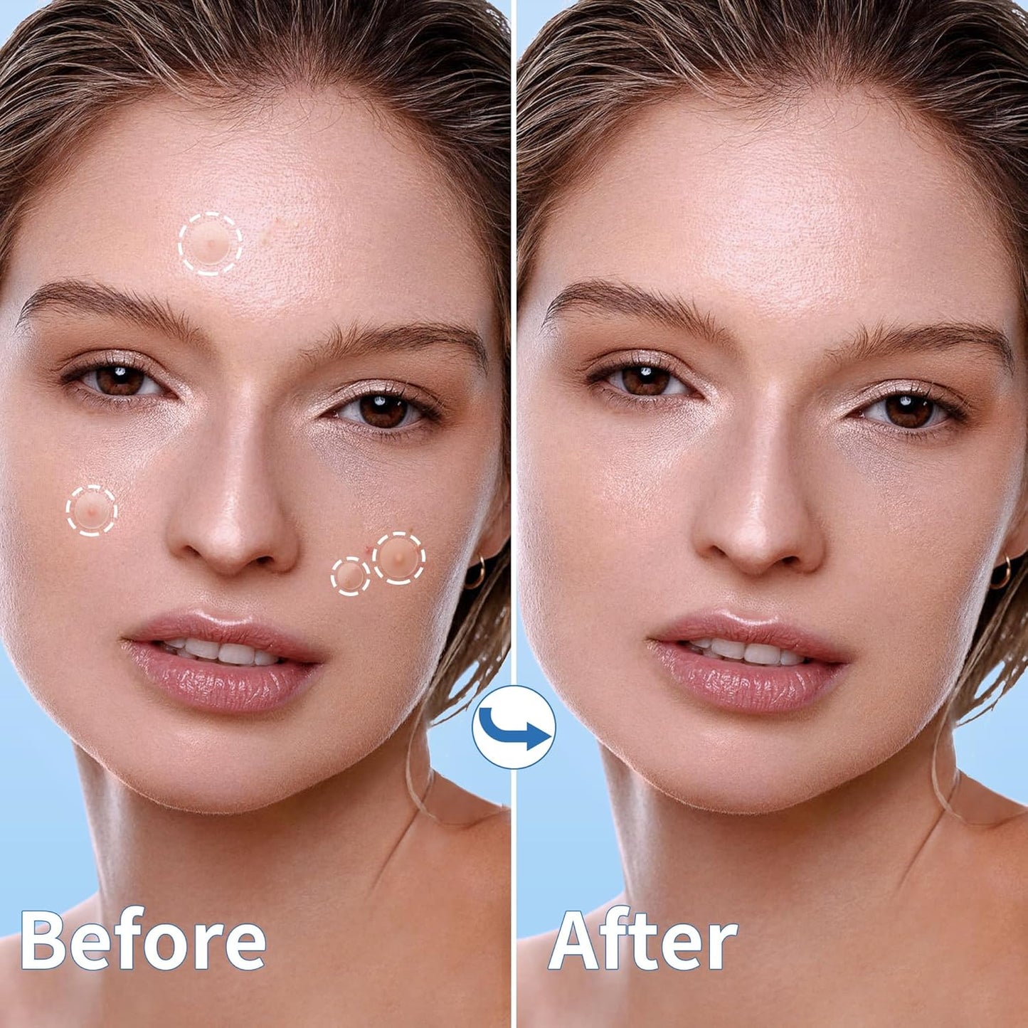 Large Hydrocolloid Acne Patches | 400 Count | Effective Zit Treatment