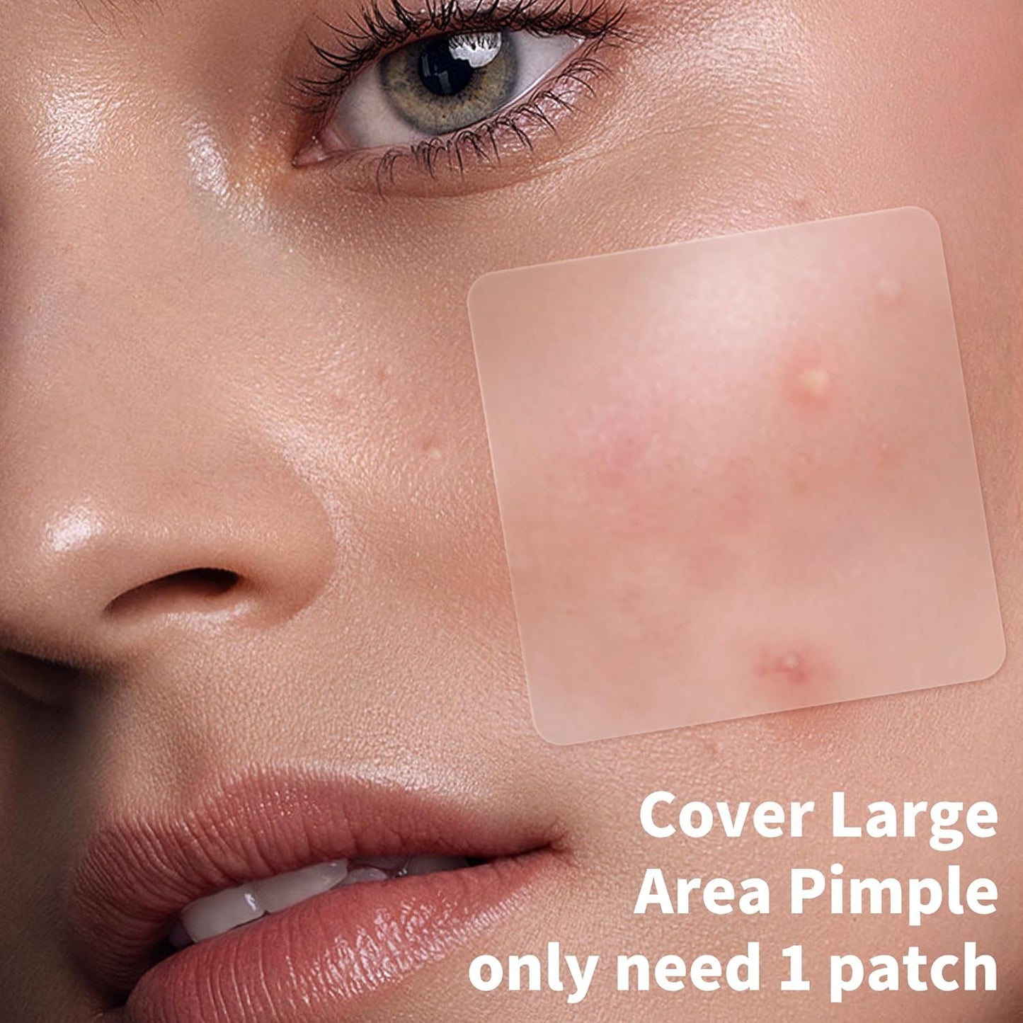 Hydrocolloid Pimple Patches | 510 Count Acne Spot Stickers with Salicylic Acid & Tea Tree Oil